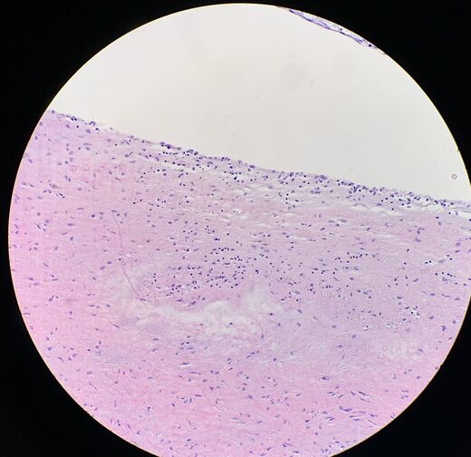 Inflamed endothelial lining.